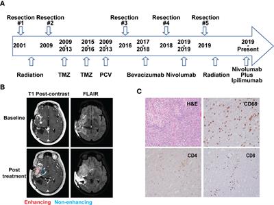 Case Report: Single-Cell Transcriptomic Analysis of an Anaplastic Oligodendroglioma Post Immunotherapy